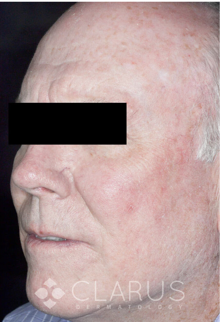After Mohs surgery reconstruction photo