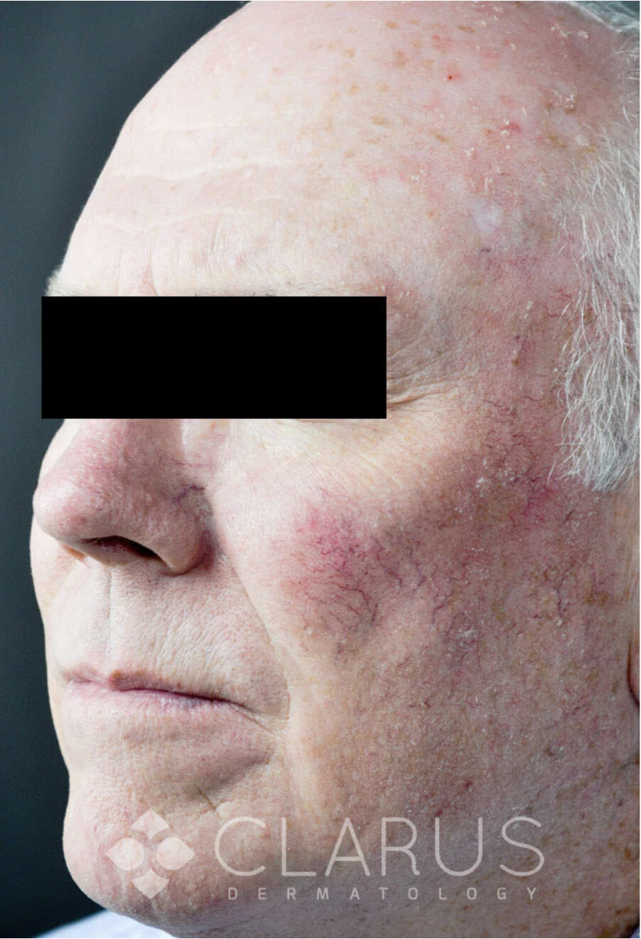 Before Mohs surgery reconstruction photo